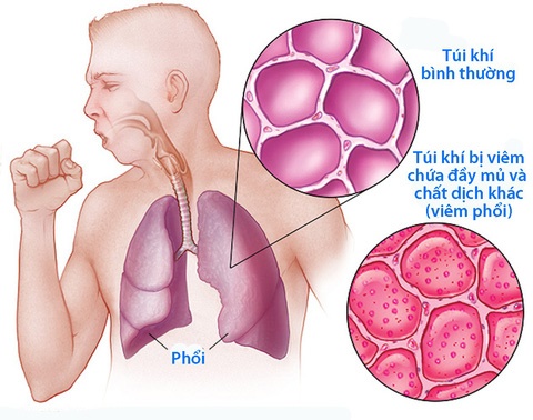 Phong viem phoi mua lanh anh 1