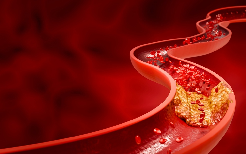 Cach giam mo mau khong can dung thuoc hinh anh