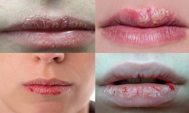nhiem herpes anh 1