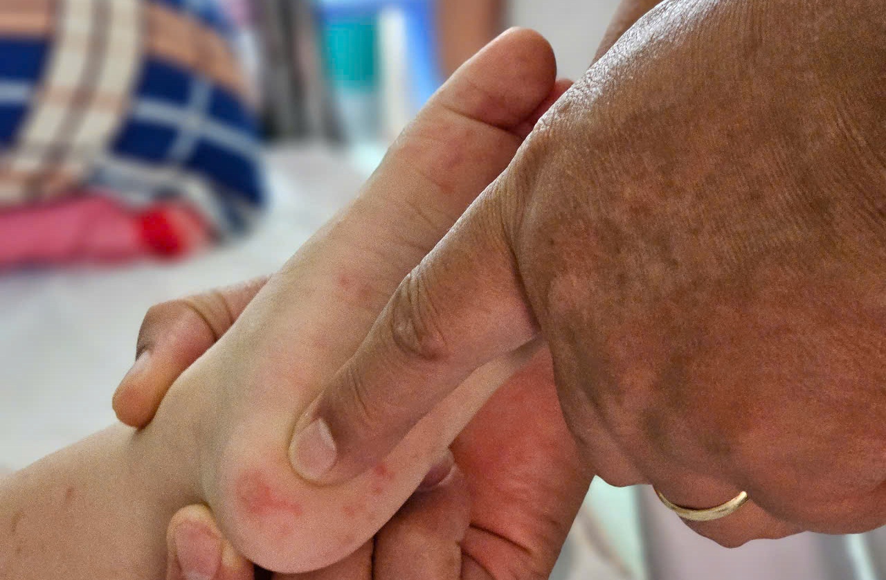 Tinh hinh cac dich benh luu hanh o TP.HCM tuan qua hinh anh