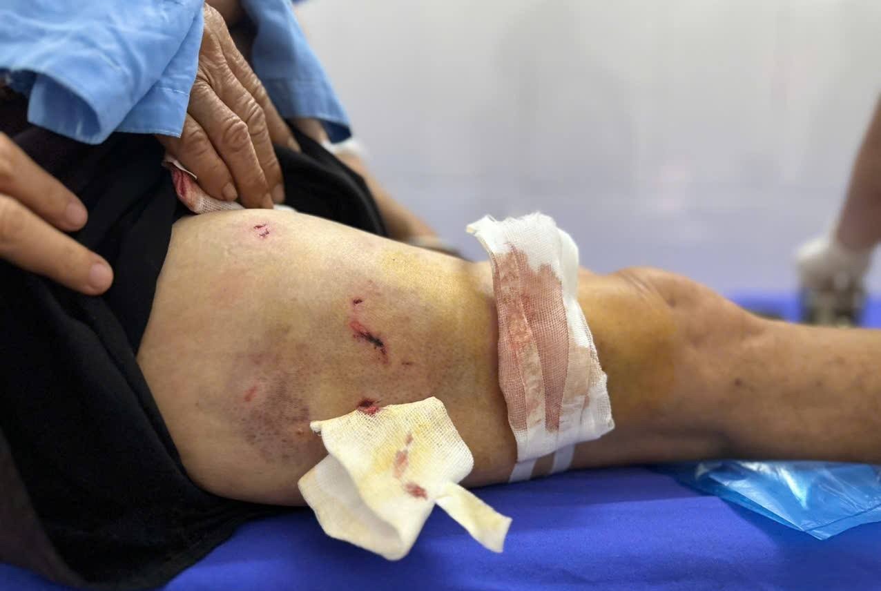 Cu ba bi dan cho can xe voi hang chuc vet thuong hinh anh