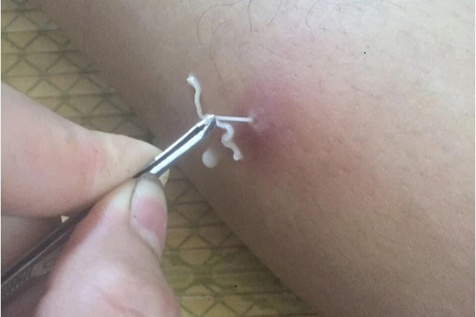 Nhiem giun rong do dau? hinh anh