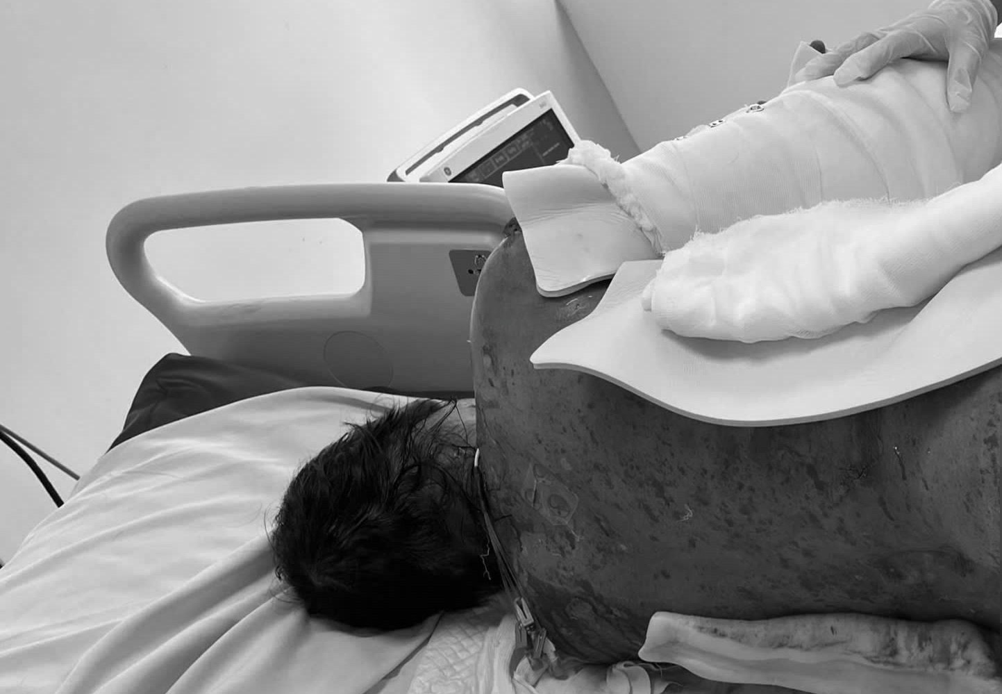 Nguoi phu nu bong troc da 92% do hoi chung hiem gap hinh anh