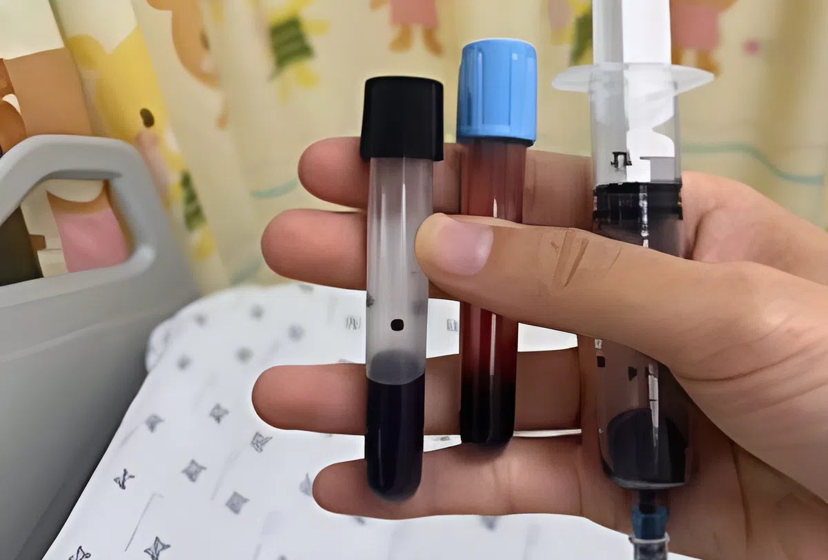 Mau be gai chuyen den do ngo doc methemoglobin hinh anh