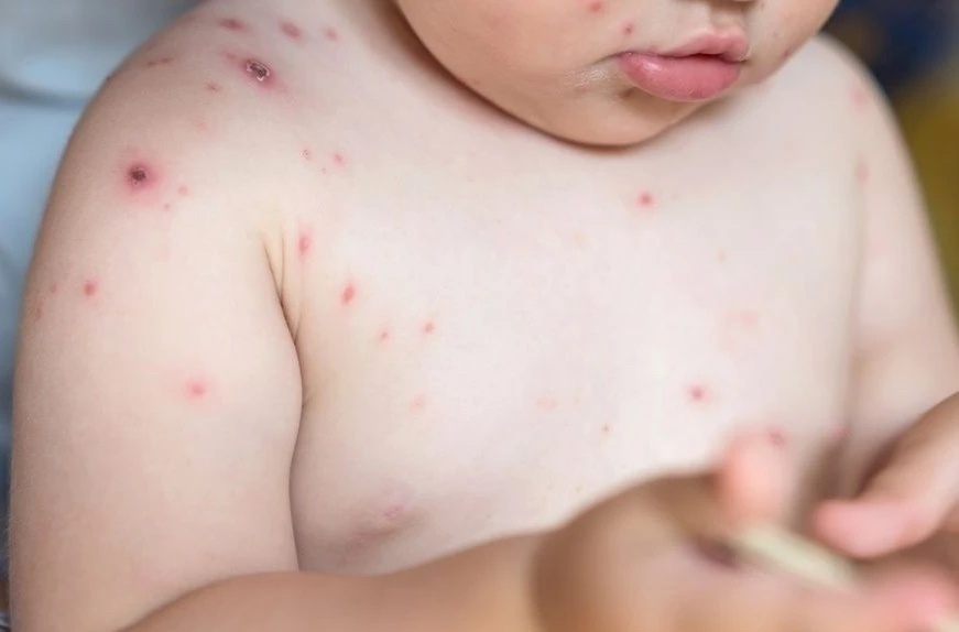 Thuy dau de lay, 85% ca nhiem tu nguoi trong gia dinh hinh anh