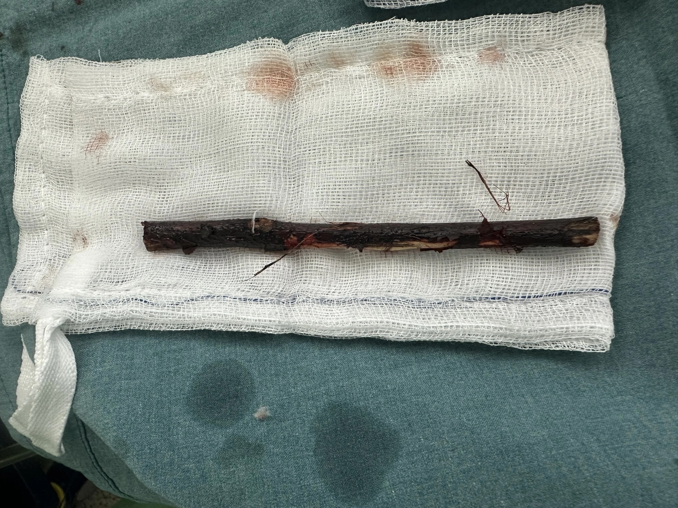 Canh cay 16 cm trong bung be 3 tuoi suot 4 thang khong hay biet hinh anh