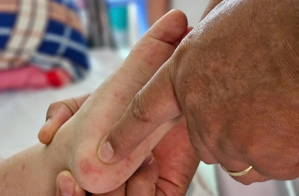 Mot benh du kien tang cao o TP.HCM, bac si khuyen cao than trong hinh anh