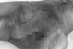 Tuyen Quang ghi nhan nhieu ca mac benh 'vi khuan an thit nguoi' sau lu hinh anh