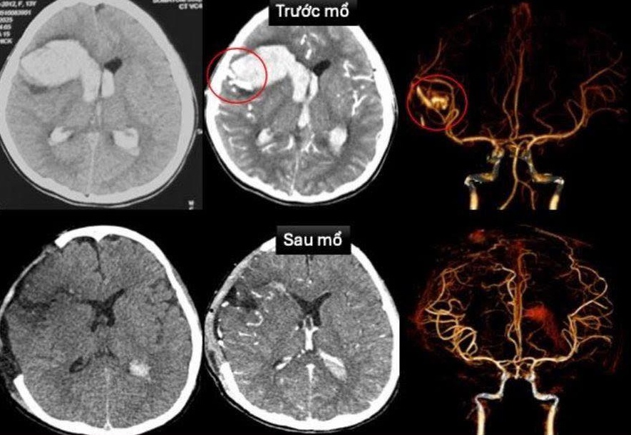 Be gai 13 tuoi vo mach mau nao, soc tim nguy kich khi dang ngu hinh anh