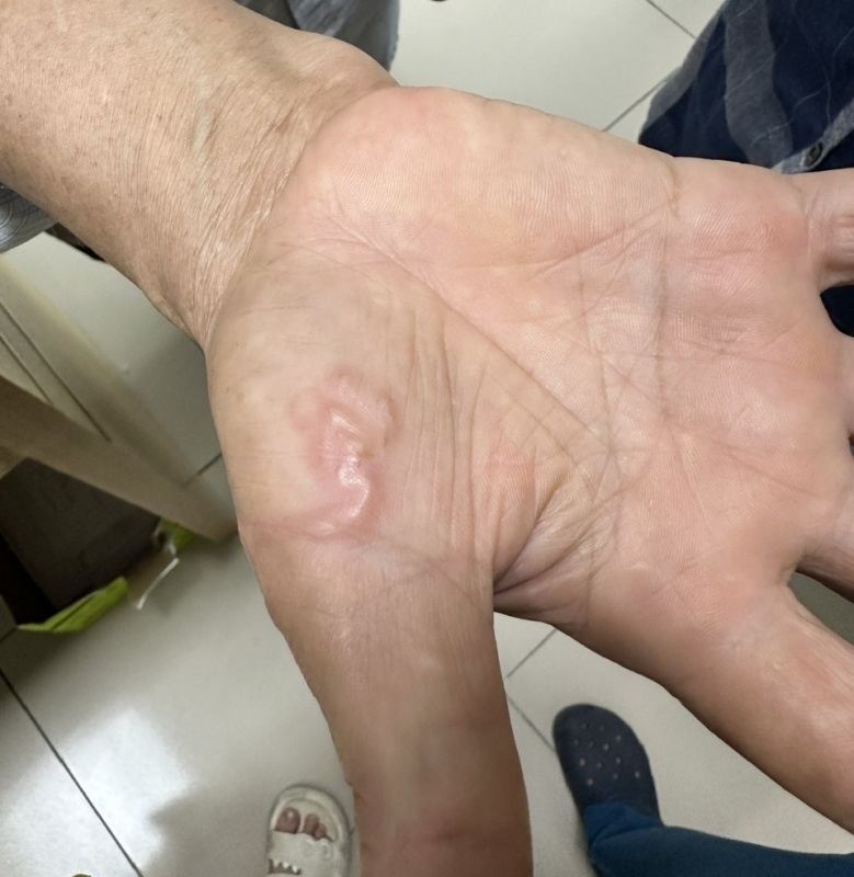 Bieu hien mac giun san anh 1