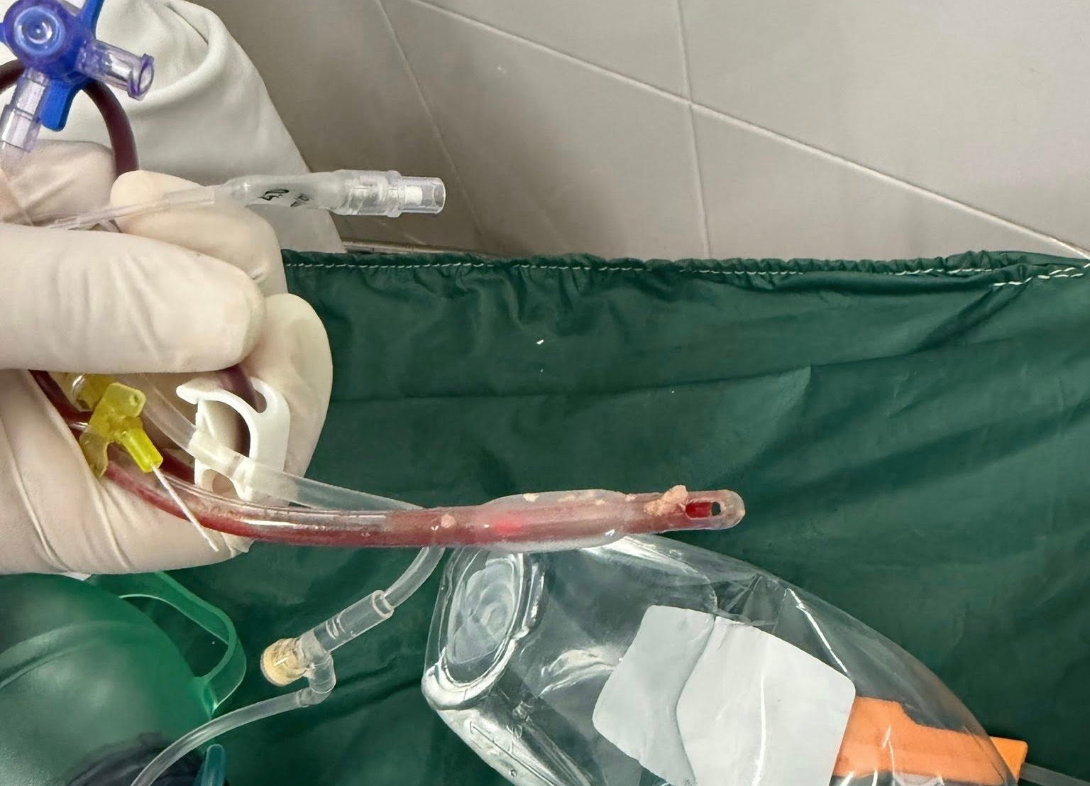 Be 3 tuoi o TP.HCM tu vong o nha tre, bac si chi ra sai lam chi mang hinh anh