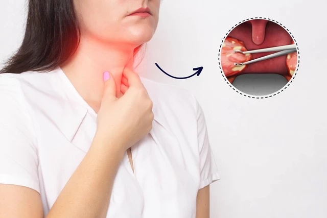 Bac si chi ra loi ich va rui ro khi cat amidan hinh anh