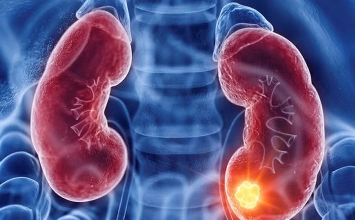 Canh bao quan trong cua ung thu than hinh anh