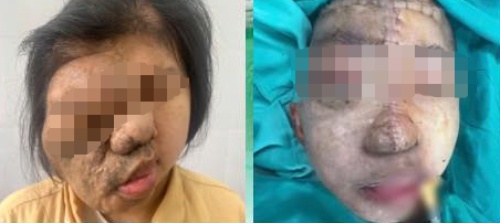 Co gai 19 tuoi mang khoi u khap dau mat co duoc phau thuat hinh anh