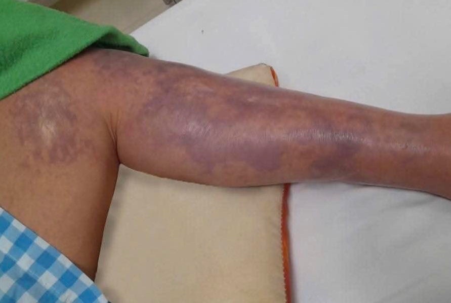 Bi vay ca dam, nguoi dan ong nhiem vi khuan 'an thit nguoi' hinh anh