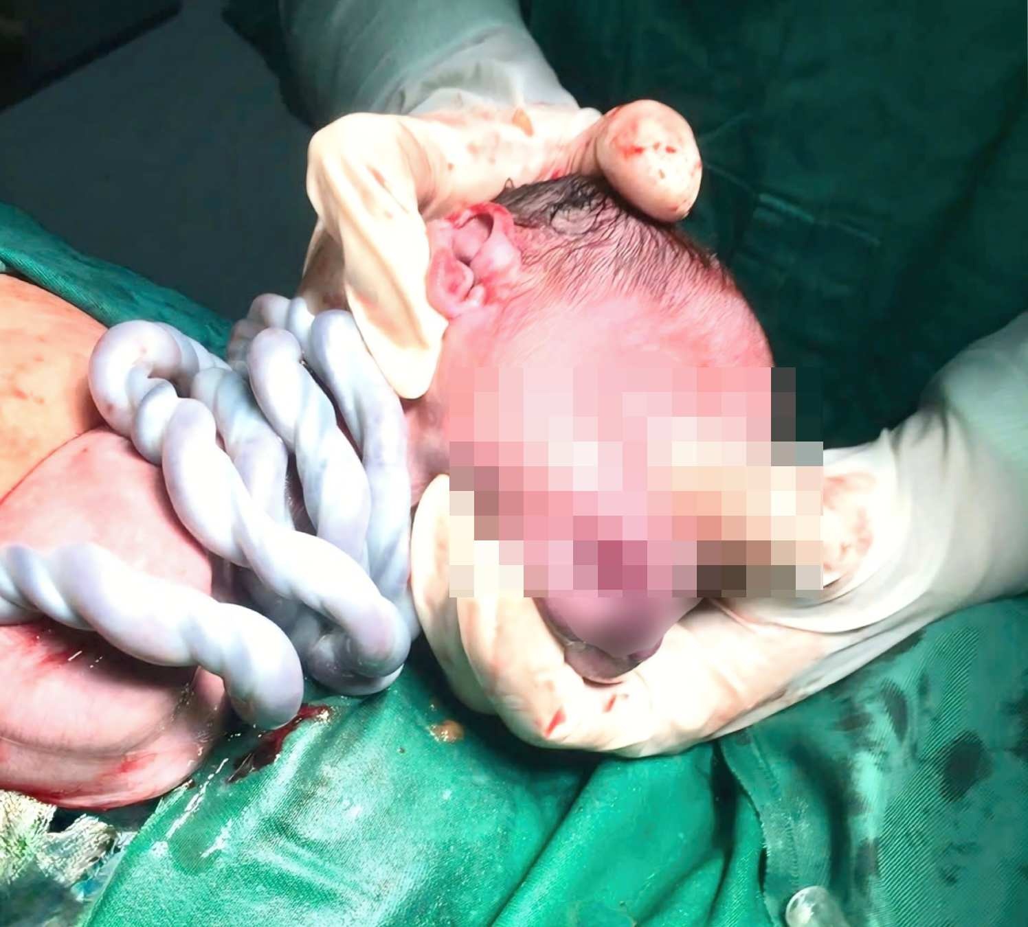 Thai nhi bi day ron quan co 5 vong hinh anh