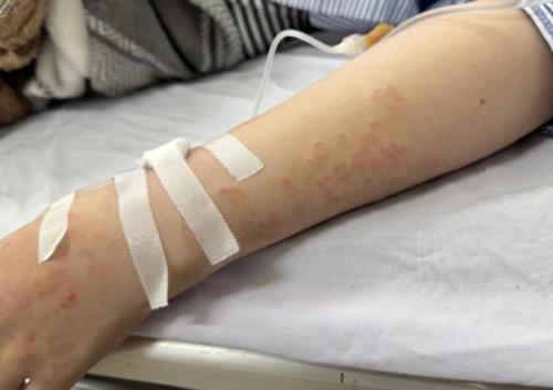 Nguoi phu nu nhiem 5 loai ky sinh trung khien bac si ngo ngang hinh anh