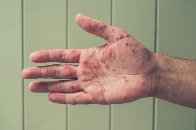 Mot benh tang soc, TP.HCM canh bao ‘song dich’ hinh anh