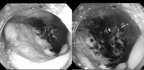 Yeu to 'nuoi duong' ung thu dai truc trang nhieu nguoi tre khong hay hinh anh