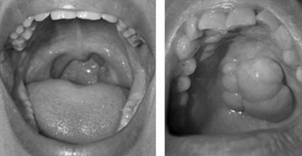 ung thu khoang mieng anh 1