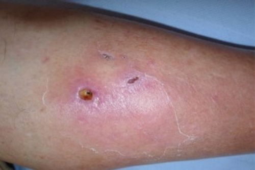 Tu vet thuong nho, nguoi dan ong bi 'vi khuan an thit nguoi' tan cong hinh anh