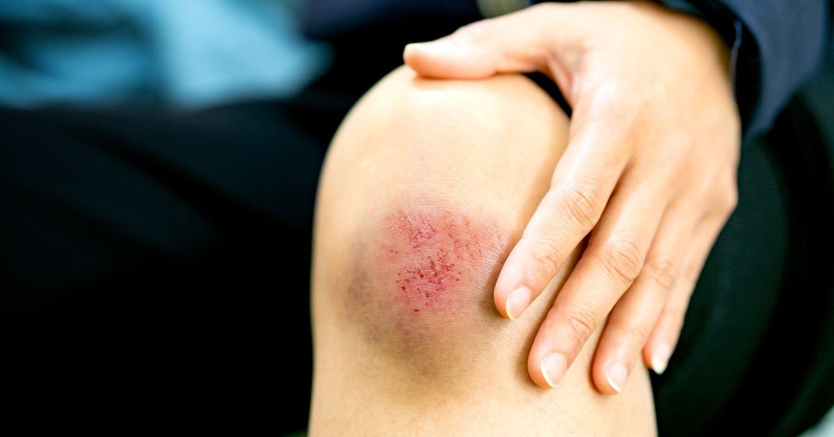 Bi tray xuoc da nen an gi de vet thuong nhanh lanh, han che seo? hinh anh