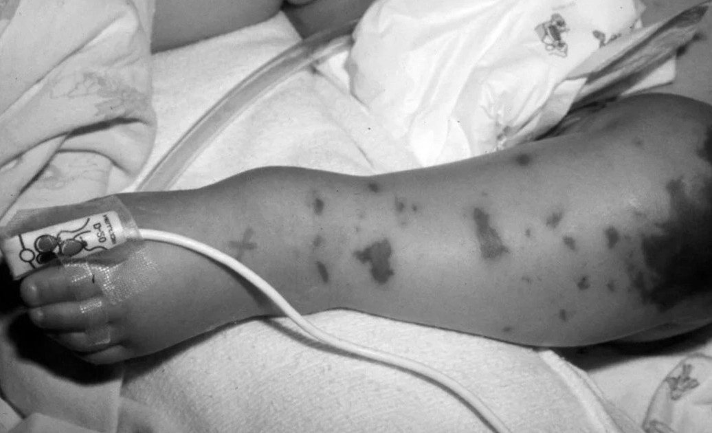 Benh nguy hiem da co 4 ca khong qua khoi, Vien Pasteur TP.HCM canh bao hinh anh