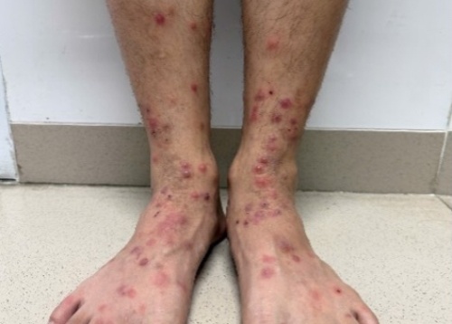 Lien tiep nguoi nhap vien voi chi chit vet do, cung mot nguyen do hinh anh