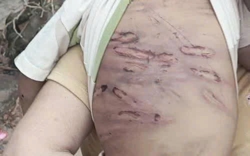 Be gai o TP.HCM chan thuong nang, nghi bi me va nguoi tinh bao hanh hinh anh
