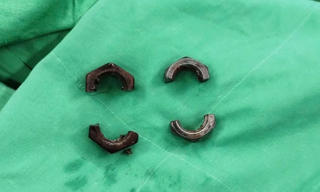 'Cau nho' bien dang vi dai oc siet, nguoi dan ong 38 tuoi di cap cuu hinh anh