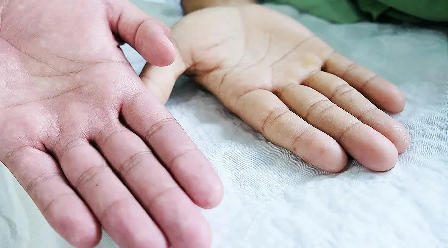 Bé 4 tuổi cấp cứu vì chỉ uống sữa thay cơm: BS chỉ ra sai lầm phổ biến