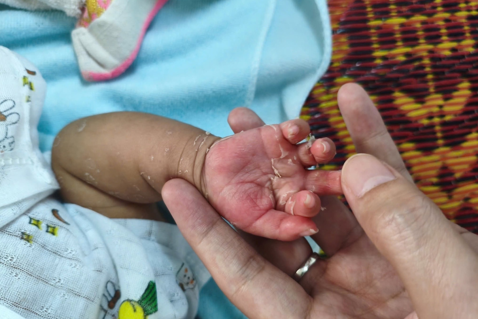 Bé 2 tháng tuổi mắc giang mai bẩm sinh