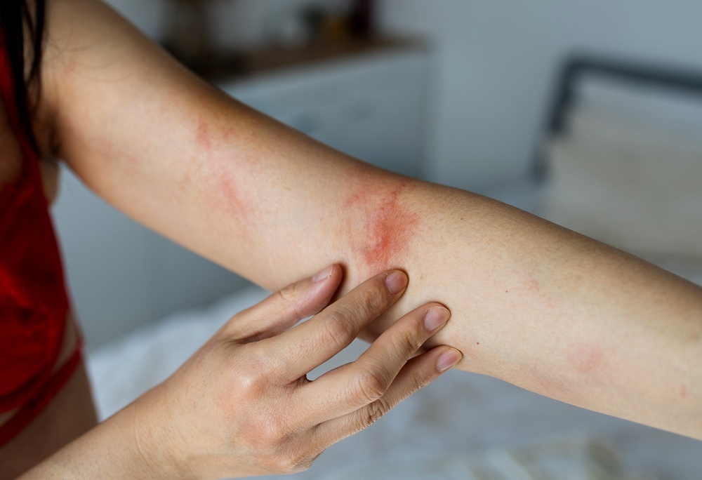 6 dấu hiệu cảnh báo tình trạng dị ứng nghiêm trọng