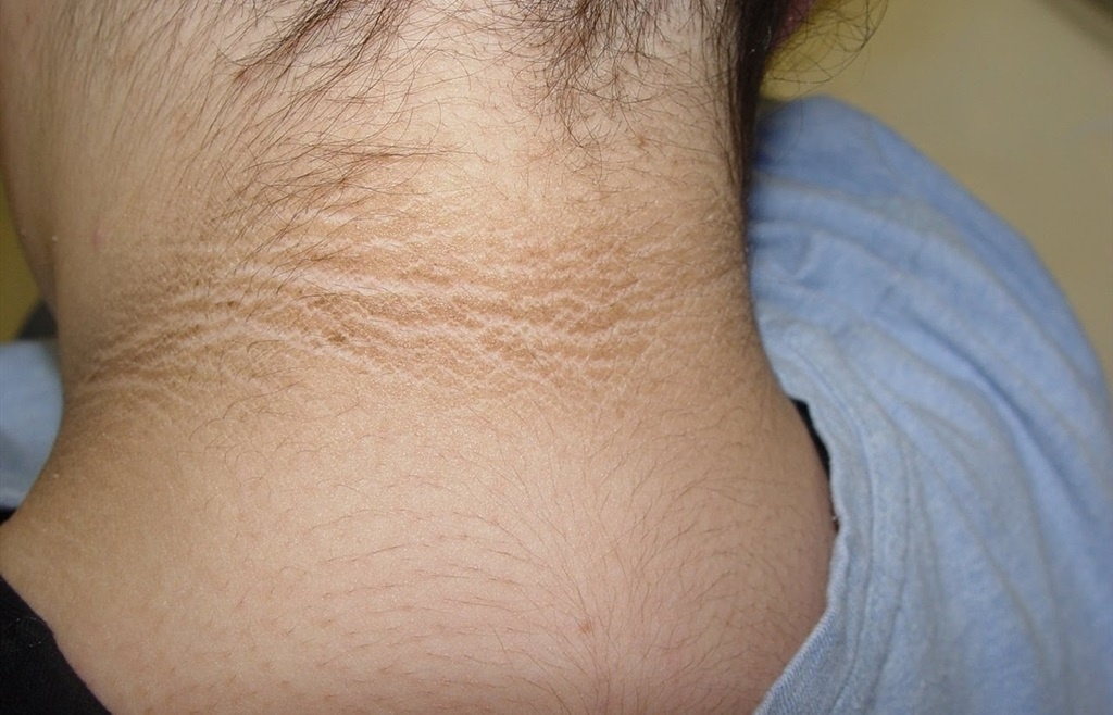 kh&aacute;ng insulin ảnh 2