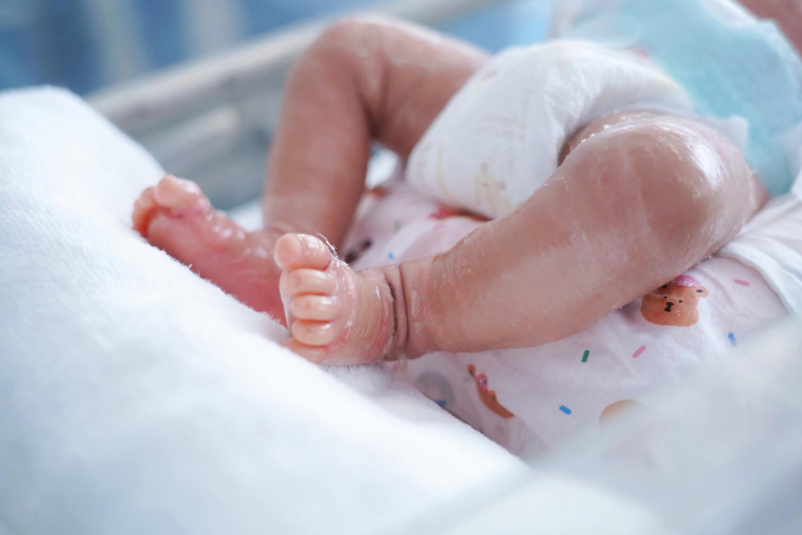 Bé trai ở TP.HCM chào đời với làn da như vảy cá