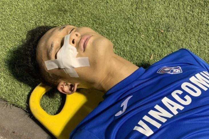 Tuyen thu U22 Viet Nam bi rach mi mat hinh anh