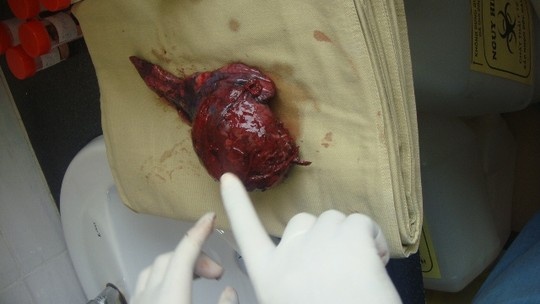 U khong lo trong phoi cua benh nhan hut thuoc la hinh anh