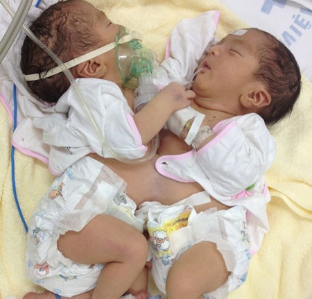 Tach thanh cong cap song sinh dinh lien bung hinh anh