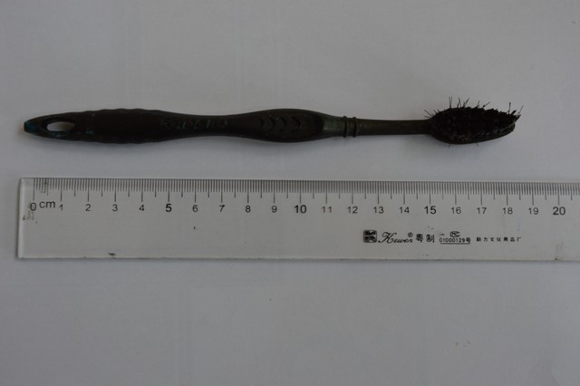 Gap ban chai 'tru' trong da day benh nhan gan 3 nam hinh anh