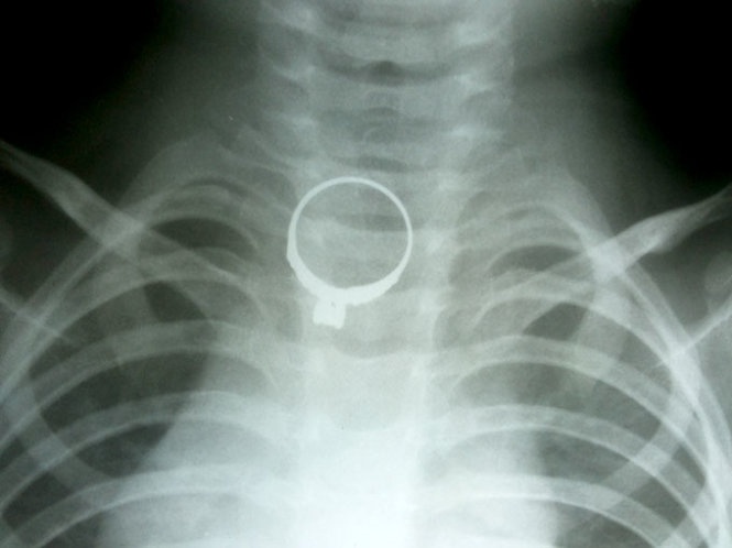 Gap nhan vang trong co hong be 2 tuoi hinh anh