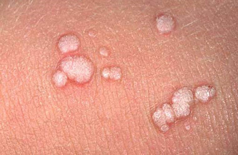 Sui mao ga co the lay qua bon cau hinh anh