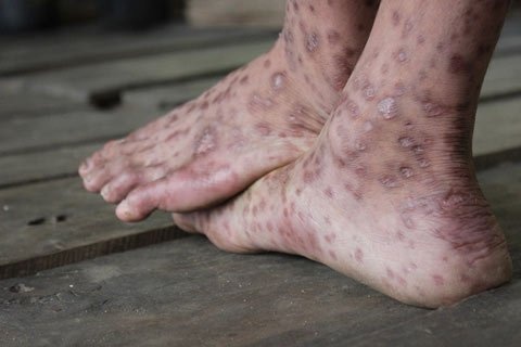 Quang Ngai: An gao moc, them 1 nguoi mac benh la hinh anh