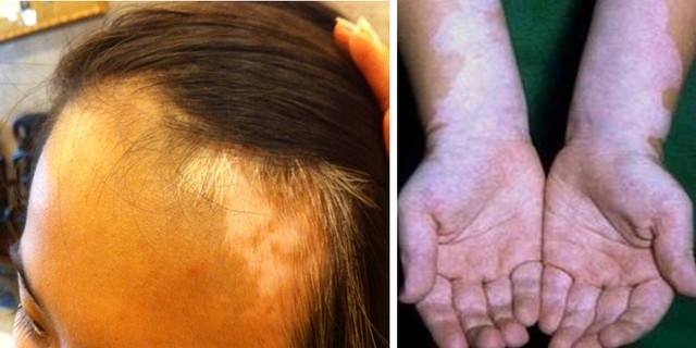 Benh bach bien va bi quyet dieu tri hinh anh