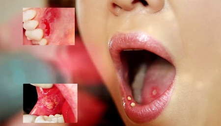 De nham lan giua nhiet, loet mieng voi ung thu khoang mieng hinh anh