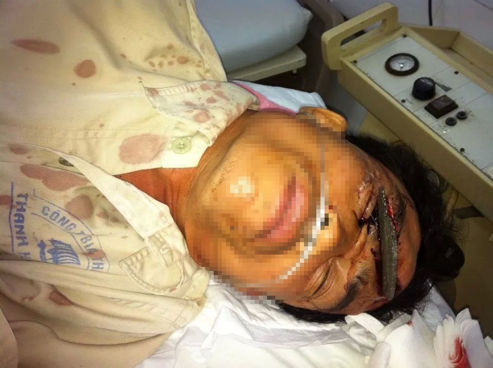 Bi 11 manh cay dam vao mat hinh anh