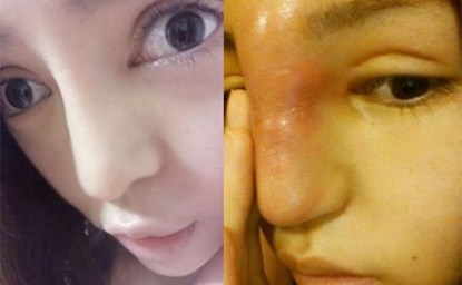 Co gai co mui to nhu voi voi sau khi 'dao keo' hinh anh