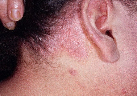 Dung thuoc nao tri vay nen hieu qua? hinh anh