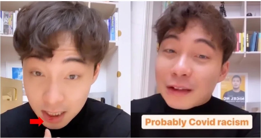 Nam vlogger bi dam vao mat vi la nguoi chau A anh 1