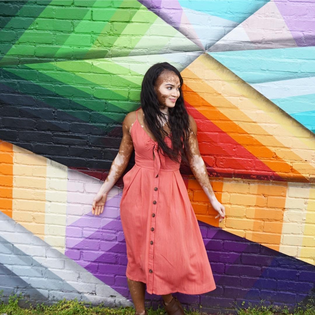 tình yêu của cô gái mắc bệnh bạch biến ảnh 2 tinh yeu cua co gai mac benh bach bien anh 2