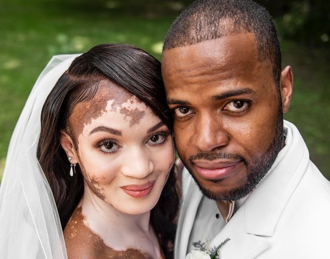 Tinh yeu dep cua co gai mac benh khien lan da loang lo hinh anh